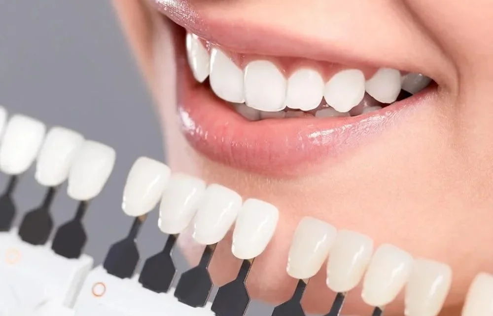 Veneer Gigi: Tren Kecantikan Gigi Yang Sedang Booming