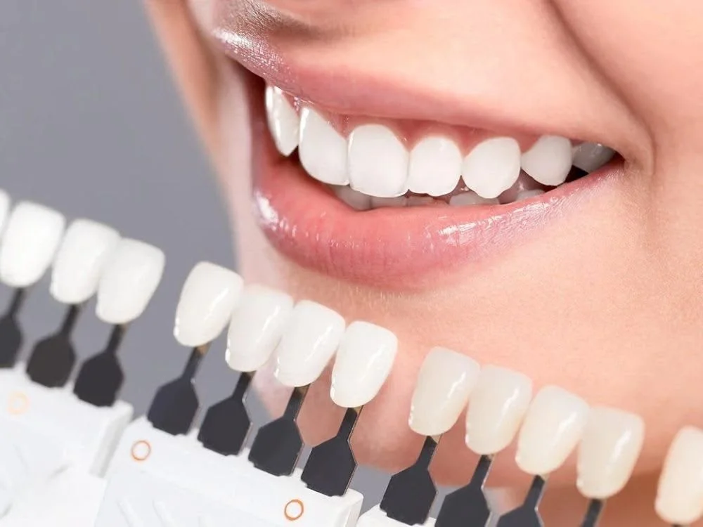 Veneer Gigi: Tren Kecantikan Gigi Yang Sedang Booming